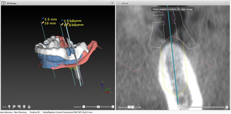 Estudio 3D para planificaci�n de implantes